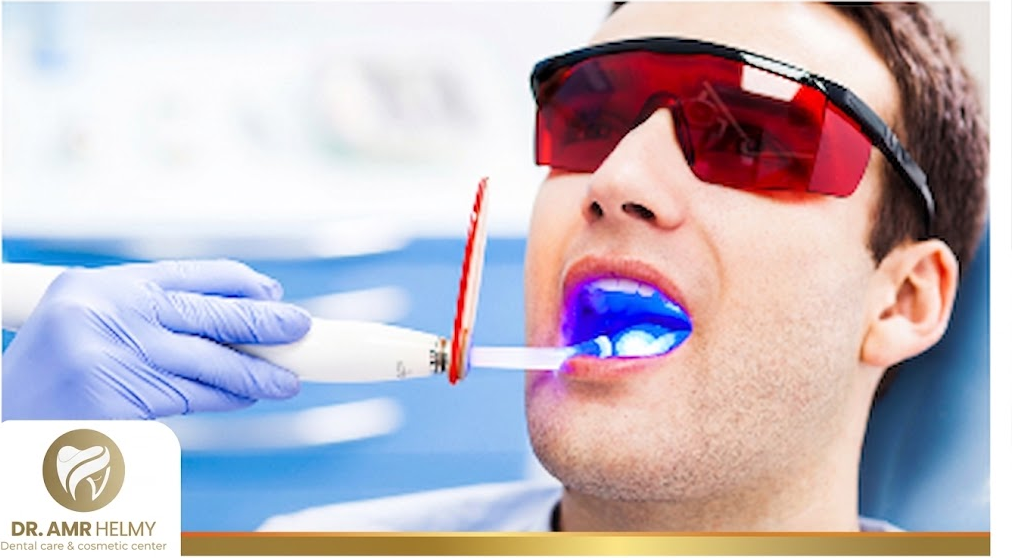 Prices of Laser Dental Fillings