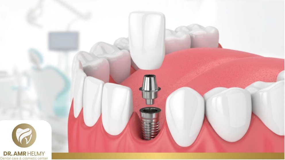 How Porcelain Teeth Are Fitted