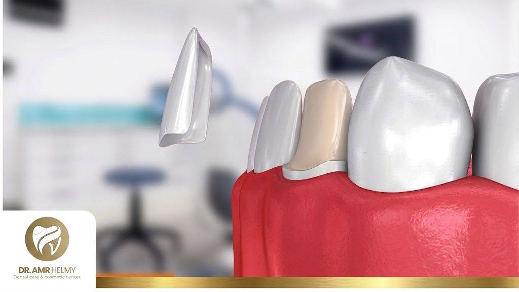 Veneer Care